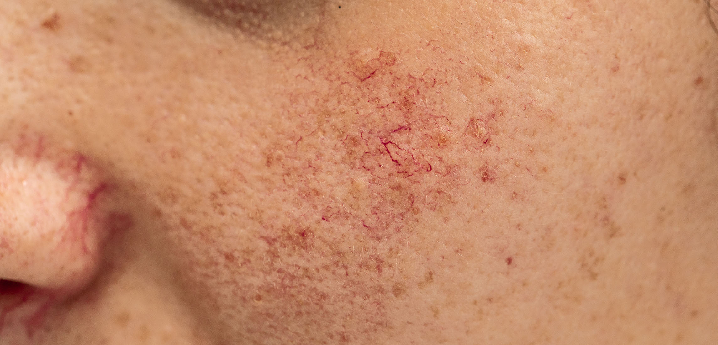 capillaries skin