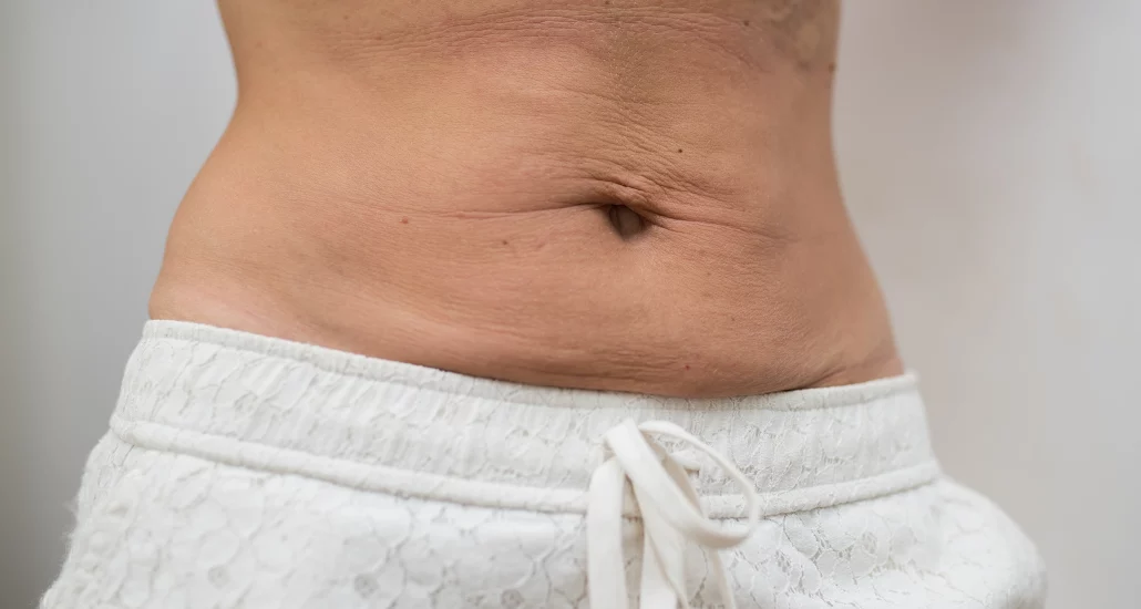 How to Tighten Loose Skin Without Surgery, Stomach