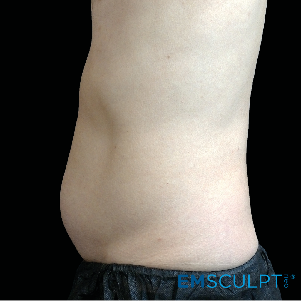 How to Lose Arm Fat  Sculpt Your Dream Arms Fast with EmSculpt